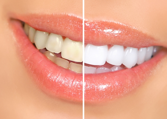 Before and after a teeth whitening service in Knoxville. 